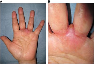 Case Report: Angiomatoid fibrous histiocytoma in the hand: a rare clinical presentation and diagnostic challenge